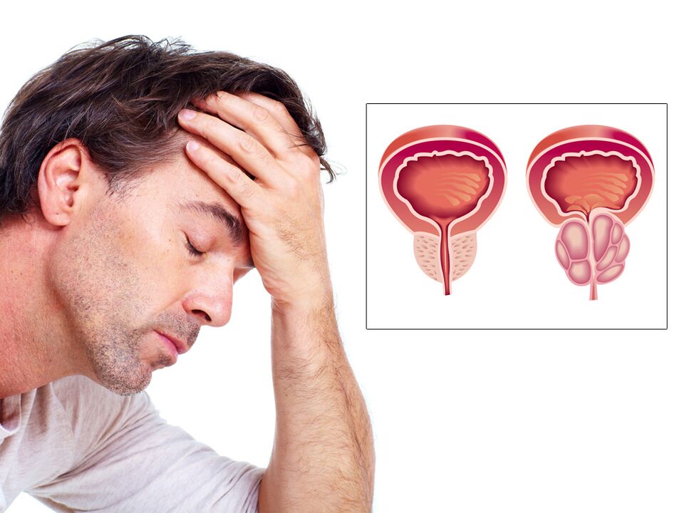 adenom prostate z impotenco
